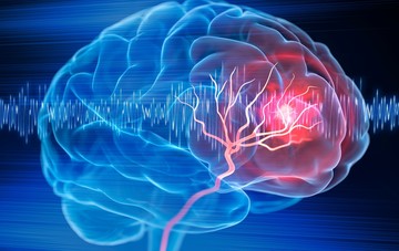 stroke, agyvérzés, d-vitamin, b12