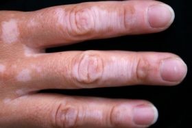vitiligo-d000009F25860917abe41