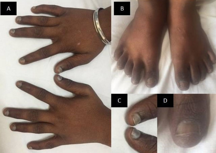 Ciemne zabarwienie paznokci u 12-letniego chłopca wynikało z niedoboru wit. B12