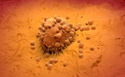 Czerniak jest nowotworem agresywnym. Sprawdź swoje znamiona i przebarwienia