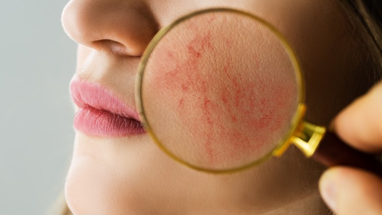 rosacea, vigyáz, tünet, romlik, napfény, étel
