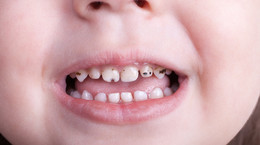 Czy leczenie zębów mlecznych różni się od leczenia zębów stałych? Ekspertka wyjaśnia
