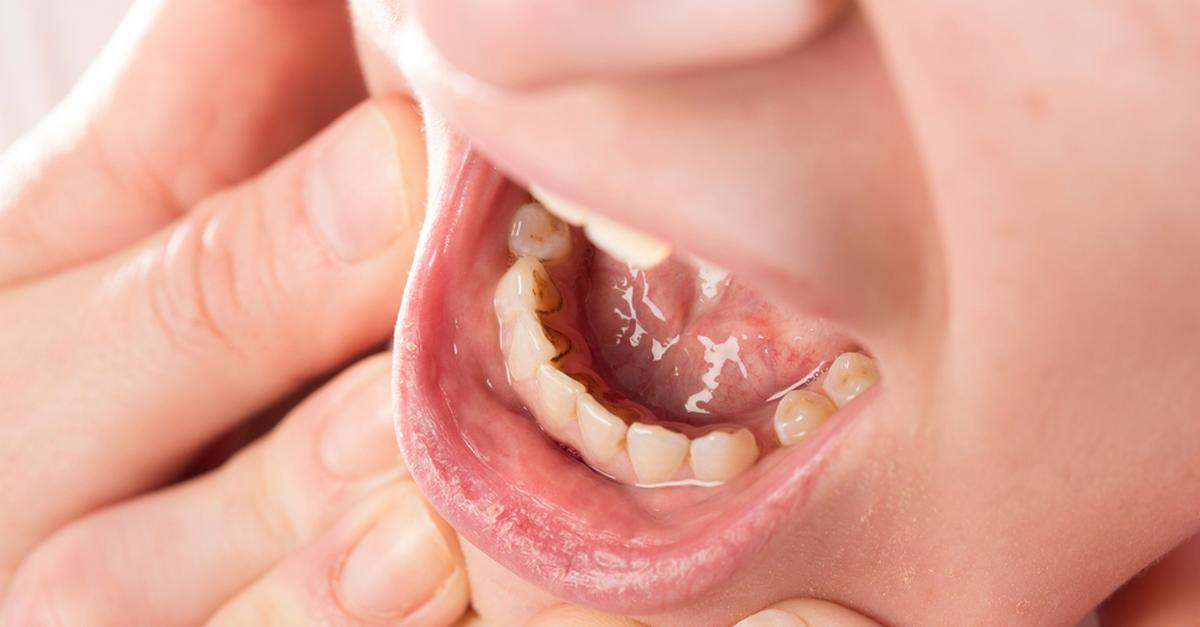Koronawirus Trzy Nowe Objawy Usta Dlonie Podeszwy Stop