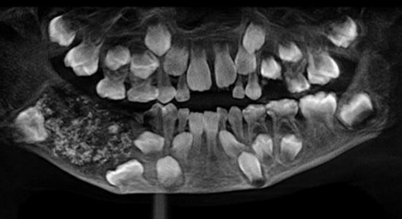 Doctors discover 526 extra teeth in 7-year-old boy’s mouth (photos)
