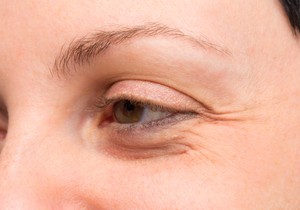 Stručnjaci otkrivaju kako da se rešite podočnjake