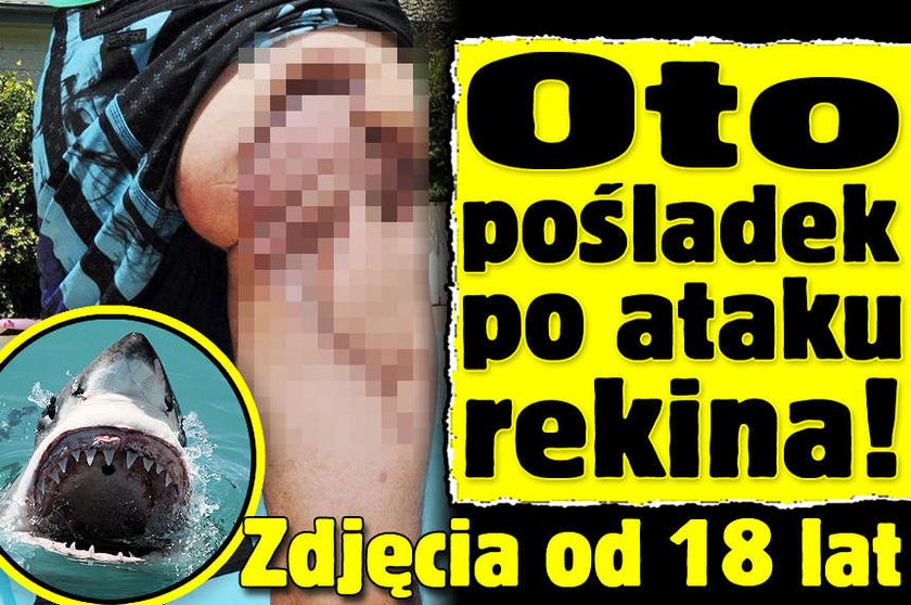 Oto pośladek po ataku rekina! FOTO od 18 lat