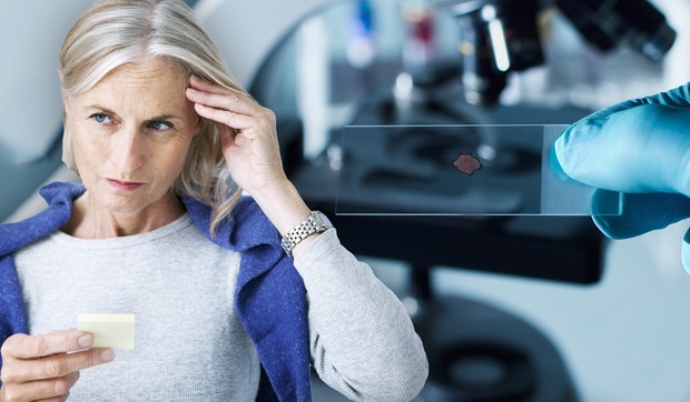 Amiloidni plakovi u mozgu pacijenta su karakterističan znak Alchajmerove bolesti 