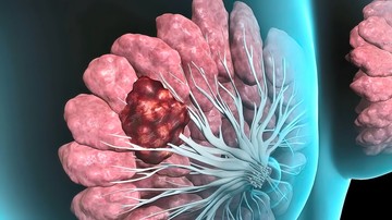 Mellrák vakcina: hihetetlen, de megtanítja a szervezetet a tumor elleni küzdelemre