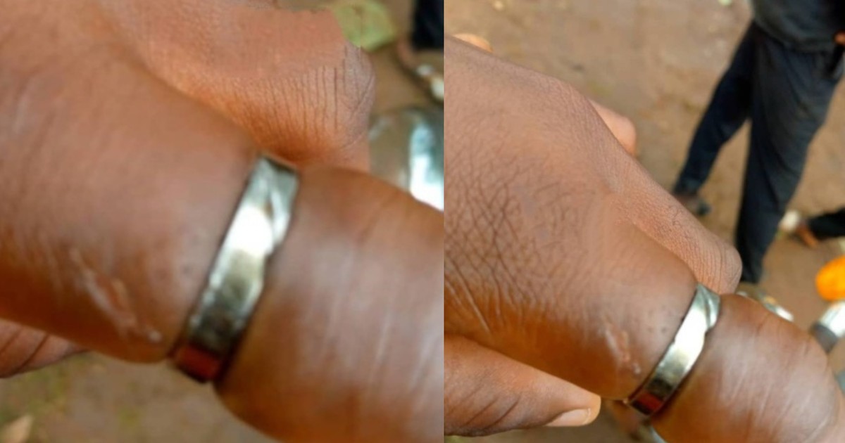 Ghanaian lady almost loses finger after wearing fiancé's promise ring - Vimarsana News