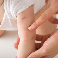 Mi okozhat kiütéseket a csecsemő bőrén? Ezek állhatnak a háttérben