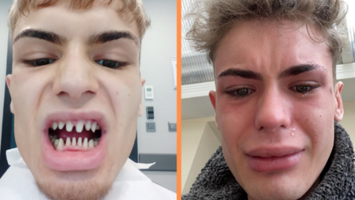 22-latek zrobił sobie "tureckie zęby". "Wyglądałem jak rekin"