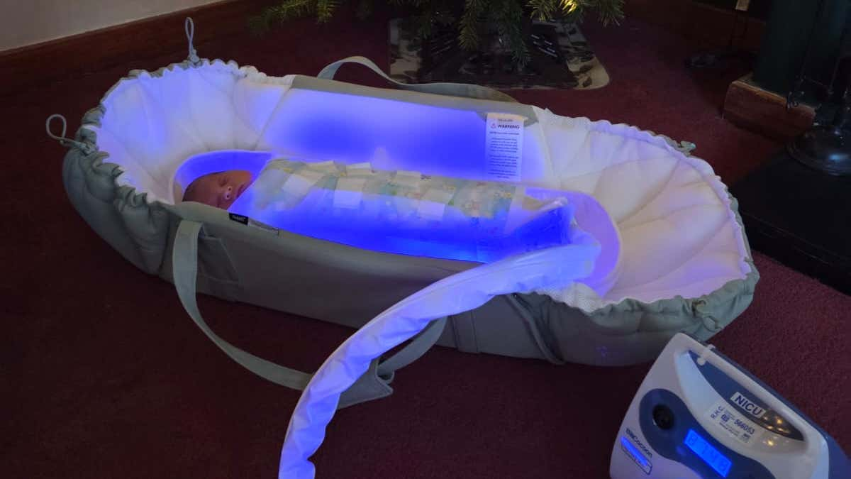 Six in 10 newborns affected: Glasgow brings jaundice treatment home
