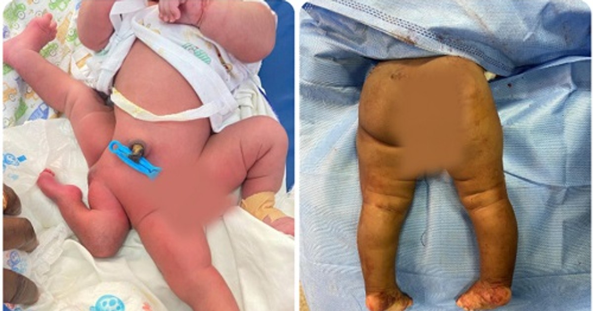 KATH doctors conduct 6-hour successful surgery on 5-month-old baby born with 4 legs - Vimarsana News
