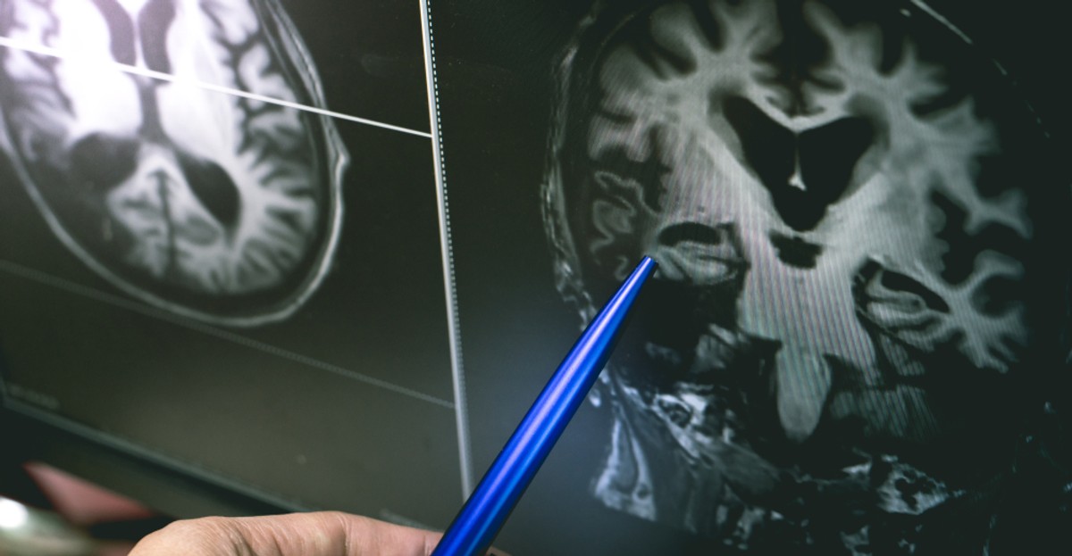 Naukowcy zbadali mózgi zmarłych na covid. Co ujrzeli? 