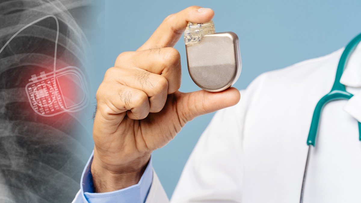 Implantabilni kardioverter-defibrilator (ICD) je mali uređaj koji stalno nadgleda srčani ritam i automatski daje elektrošokove u slučaju opasnih aritmija