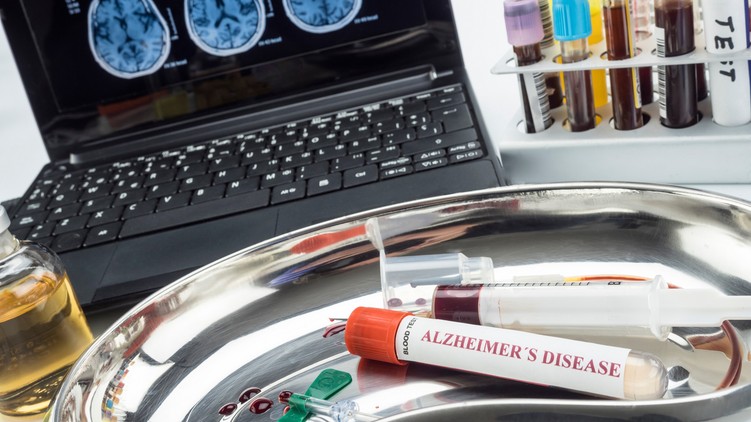Alzheimer-kór diagnózis vérvizsgálat