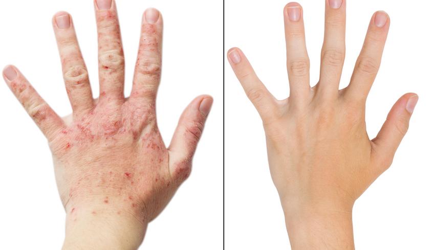 stressz dermatitis