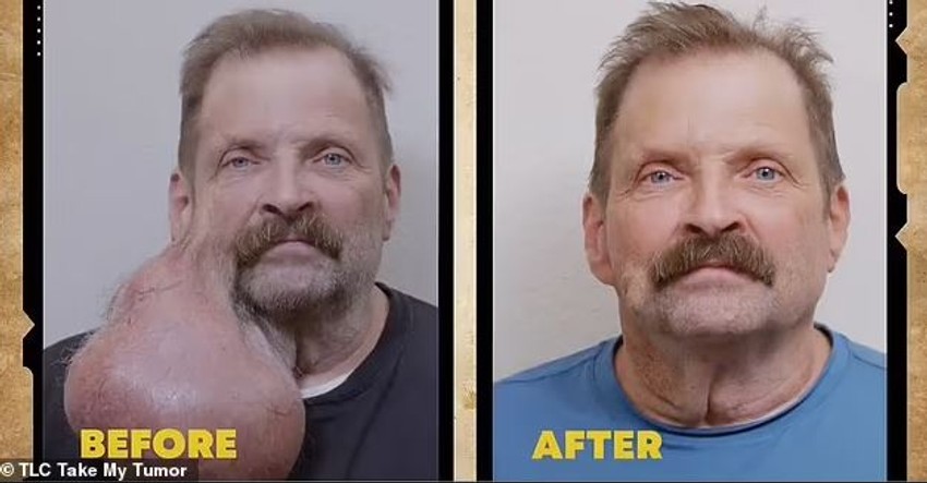 Tumor koji je Tim imao godinama na licu