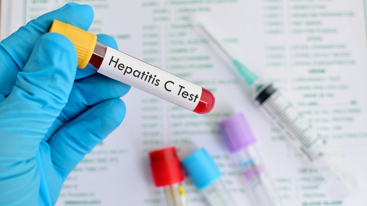 hepatitis c