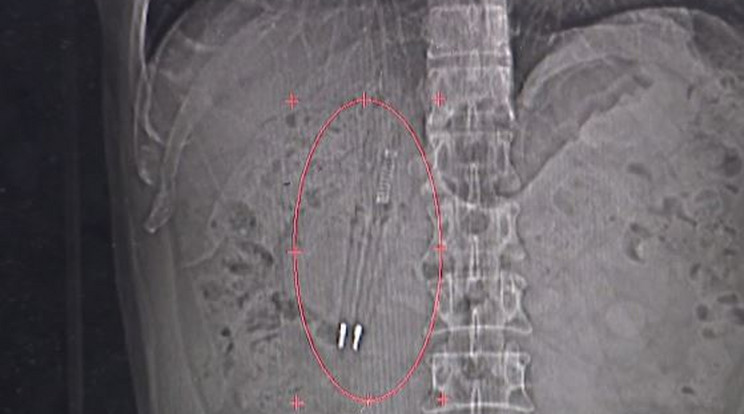Véletlenül fedezték fel  a 36 éve a férfi gyomrában lapuló két tollat. A rutinvizsgálatból  készült röntgenképen tisztán kivehetőek.