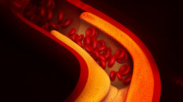 Zaskakujące, co ci podnosi cholesterol! Nie zawsze chodzi o dietę