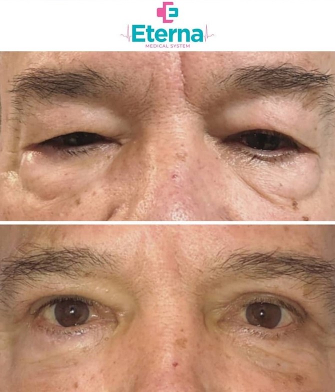 Blefaroplastika, kapci, primer