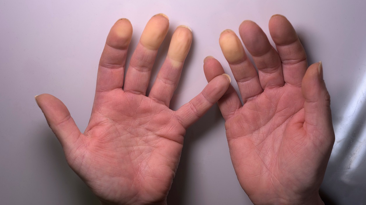 Hypotermia prestáva byť teóriou a stáva sa reálnou hrozbou.