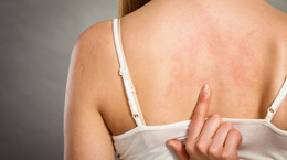 Pokrzywka alergiczna - objawy, rodzaje, leczenie, profilaktyka