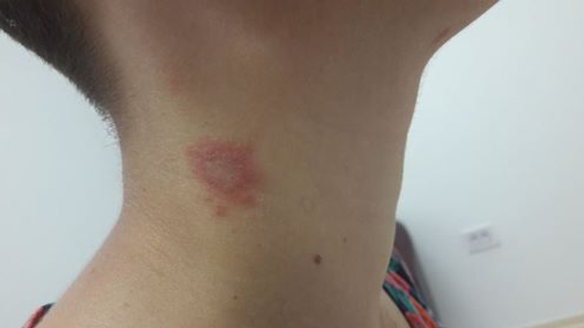 opekotina od insekta "pederus pederus"