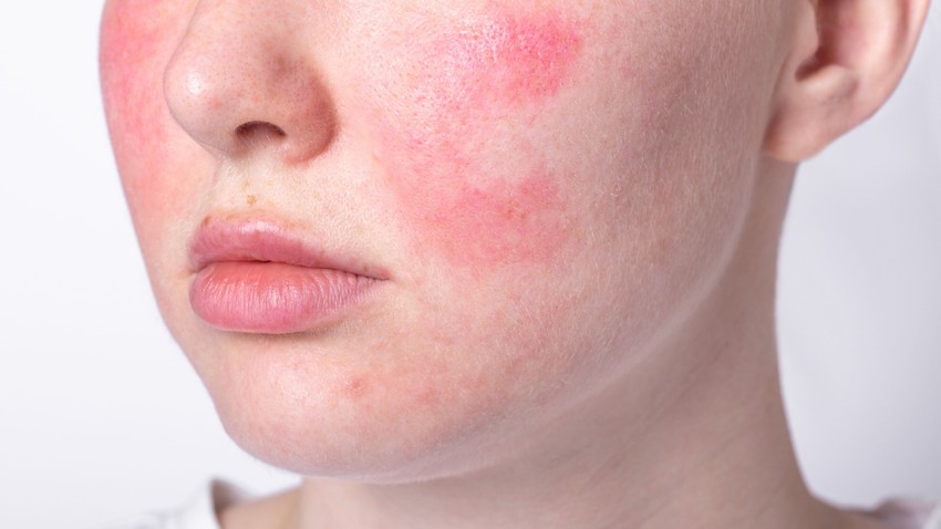 égő vörös arc oka rosacea klimax hormonzavar