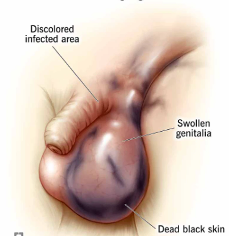 Rani simptomi Furnijeove gangrene uključuju promenu boje kože i otok genitalija
