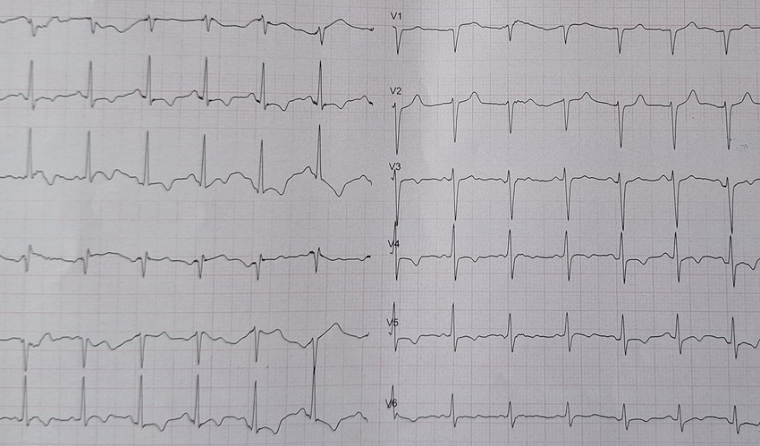 EKG srca