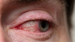 Síntomas de conjuntivitis alérgica: no debe ignorarlos