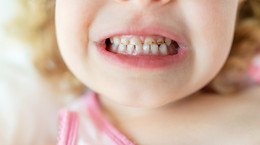 Jak radzić sobie z próchnicą u dziecka? Dentystka podpowiada