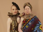 7 daily challenges people living with albinism in Nigeria face
