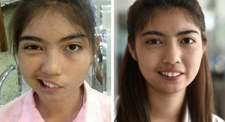 A photo combo by Paveena Foundation in 2016 and AFP's Lillian Suwanrumpha in 2017 of Thai schoolgirl Naruedee Jotsanthia who was left facially disfigured after a schoolteacher who threw a mug at her head