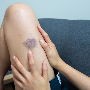 Ízületi fájdalom, kiütések, véraláfutások: ezekkel is jelezhet a leukémia