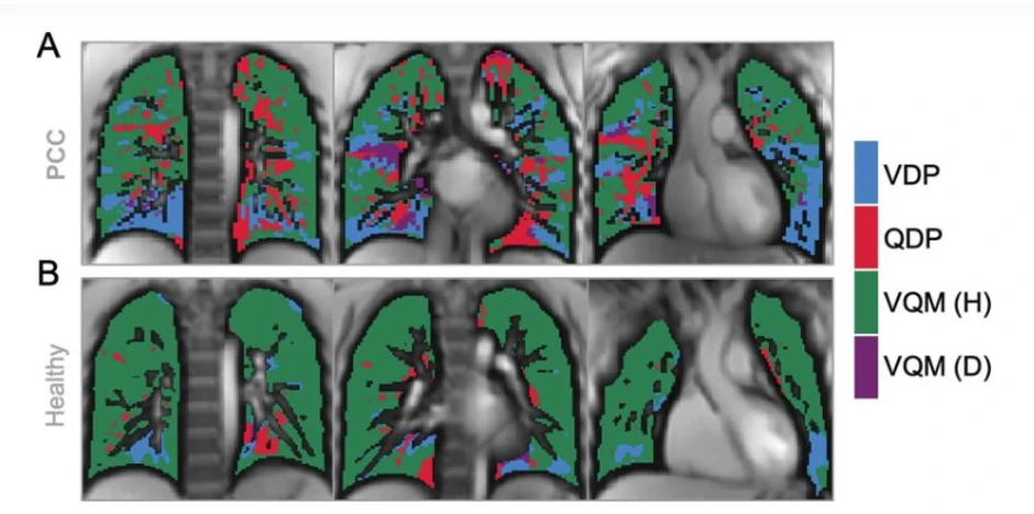 U poređenju sa zdravom, deca sa dugim COVID-om imali su značajno smanjen protok krvi u plućima