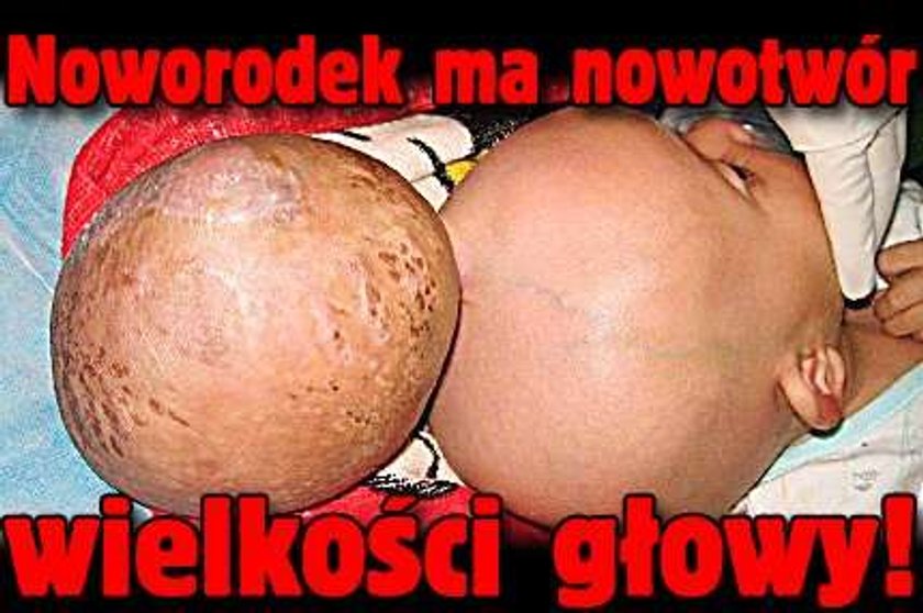 Noworodek z nowotworem wielkości głowy