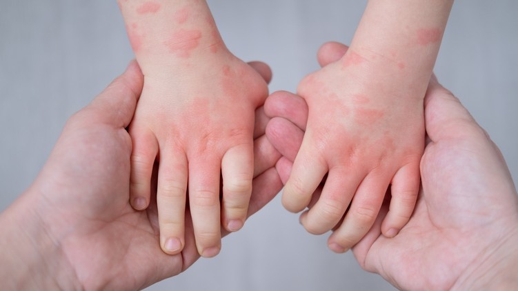 gyermekkori ételallergia allergiavizsgálat