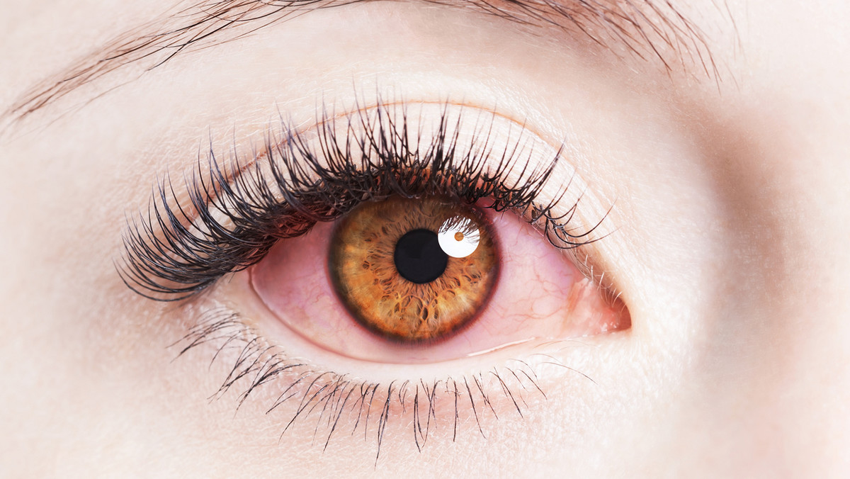 Opisana przez lekarza okulistę Friedricha Hornera choroba – zespół Hornera, powoduje uszkodzenie współczulnego unerwienia oka, które jest odpowiedzialne za przewodzenie impulsów z pnia mózgu do oka. Skąd bierze się tego typu schorzenie i jak je leczyć?