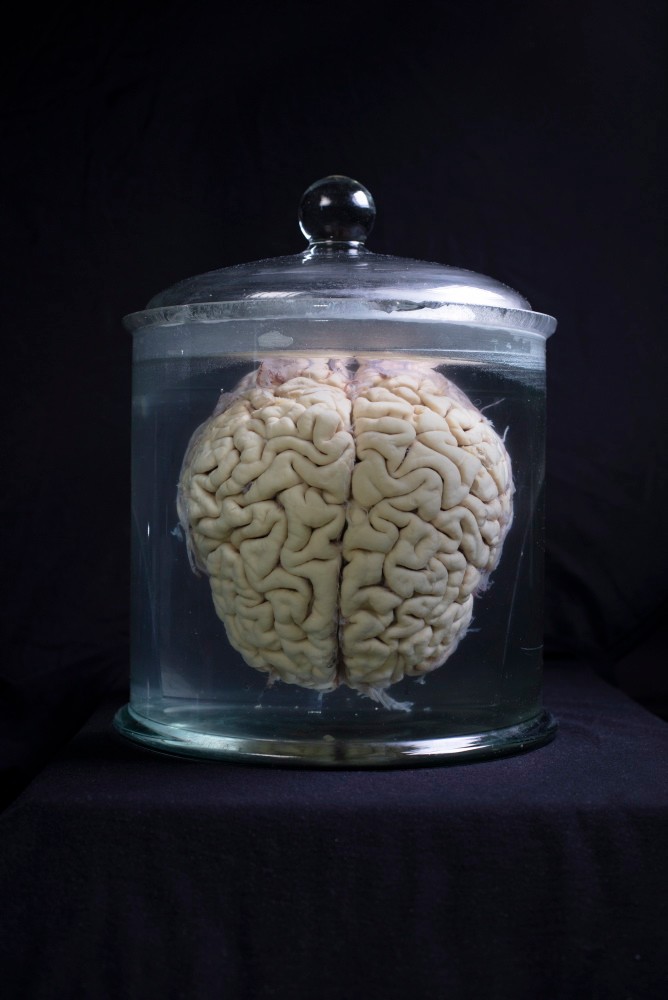 El cerebro de un hombre de 73 años que murió de un derrame cerebral.  La autopsia mostró una estructura típica de las personas con síndrome de demencia.