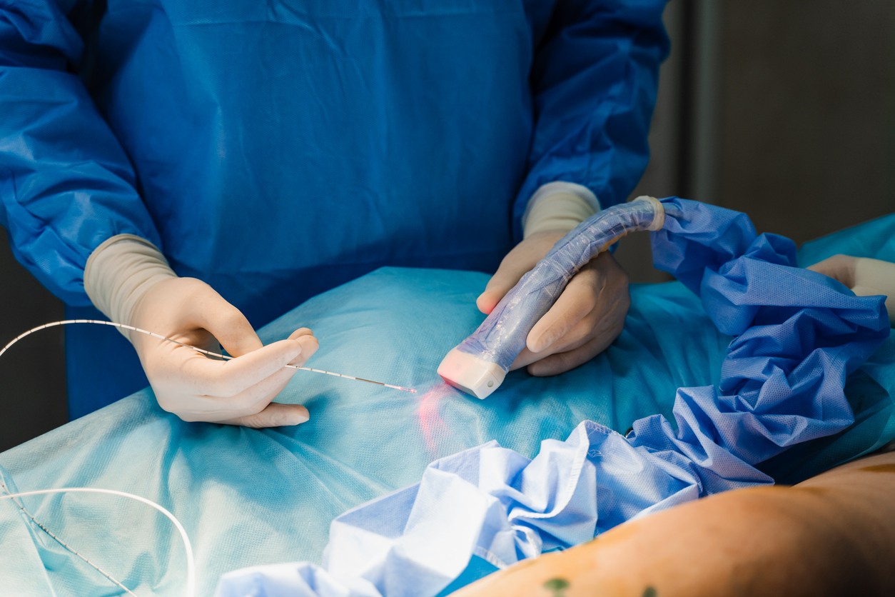 Laserové svetlo možno pri niektorých medicínskych zákrokoch privádzať do tela pomocou tenkého optického vlákna. Nová experimentálna terapia rakoviny pankreasu využíva podobný princíp na aktiváciu svetlocitlivého lieku v presne určenej oblasti. (Ilustračný obrázok)