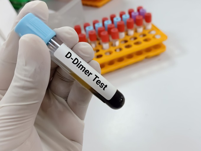 Mit jelent a D-dimer érték a laborleleten?