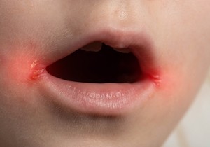 Impetigo na licu najpre počinje oko usta i nosa