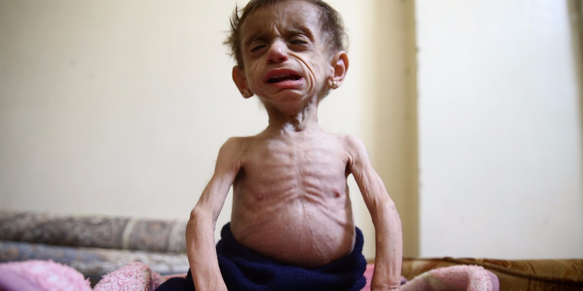 This shocking photo of a starving Syrian girl shows the barbarity of Syria's civil war