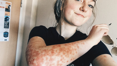 Ma már büszkén vállalja önmagát a bőrbetegsége miatt évekig szenvedő tinilány – fotók