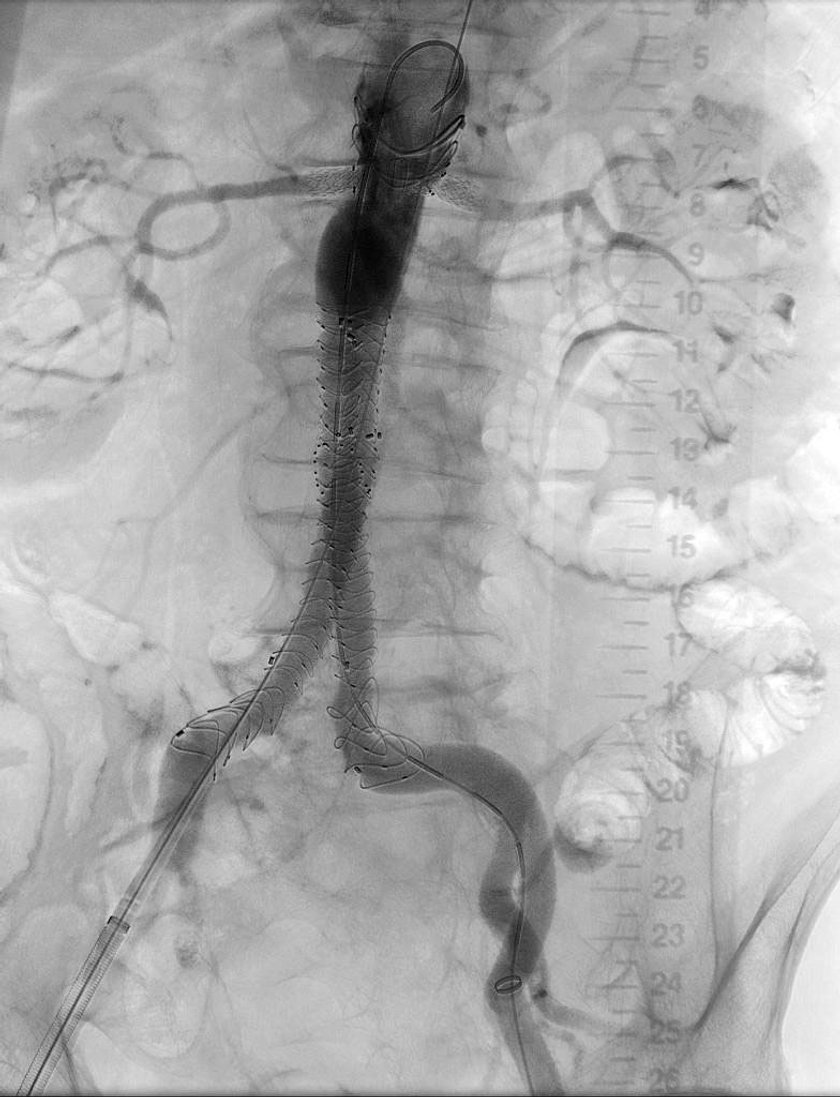 Tętniak aorty brzusznej wyłączony z krążenia