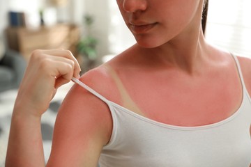 Napégés ellen: ez az alapvitamin nagy dózisban enyhítheti a tüneteket