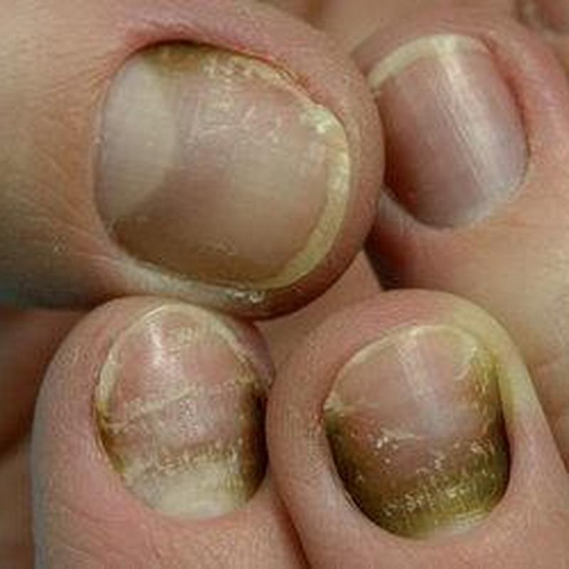 nail fungush a talpak jelei és tünetei)